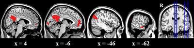 Dysfunction of the Prefrontal Cortex in Betel-Quid–Dependent Chewers